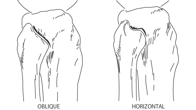 近位脛腓関節の関節面の傾斜角度による分類