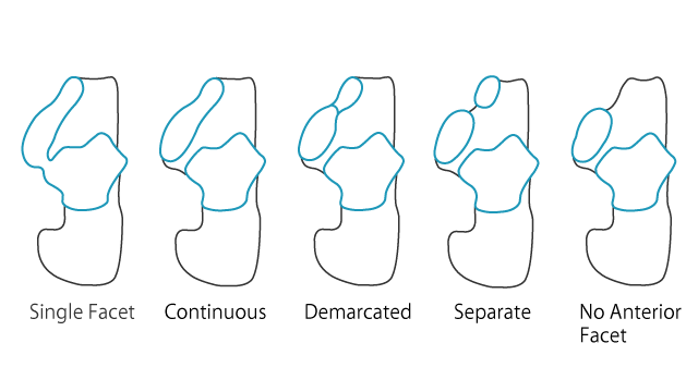 踵骨の距骨関節面の 5 型分類