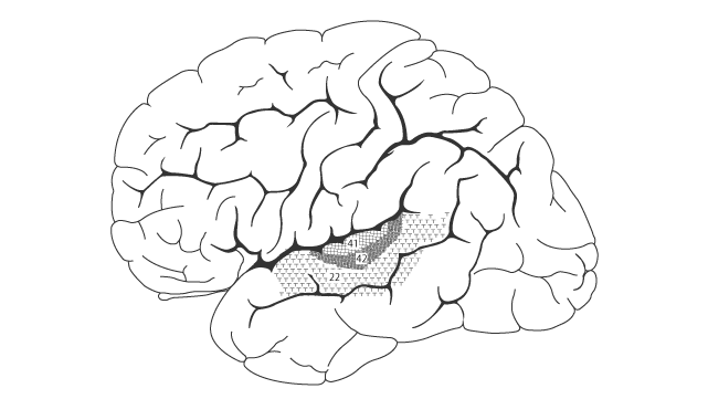 Brodmann 第 22・41・42 野